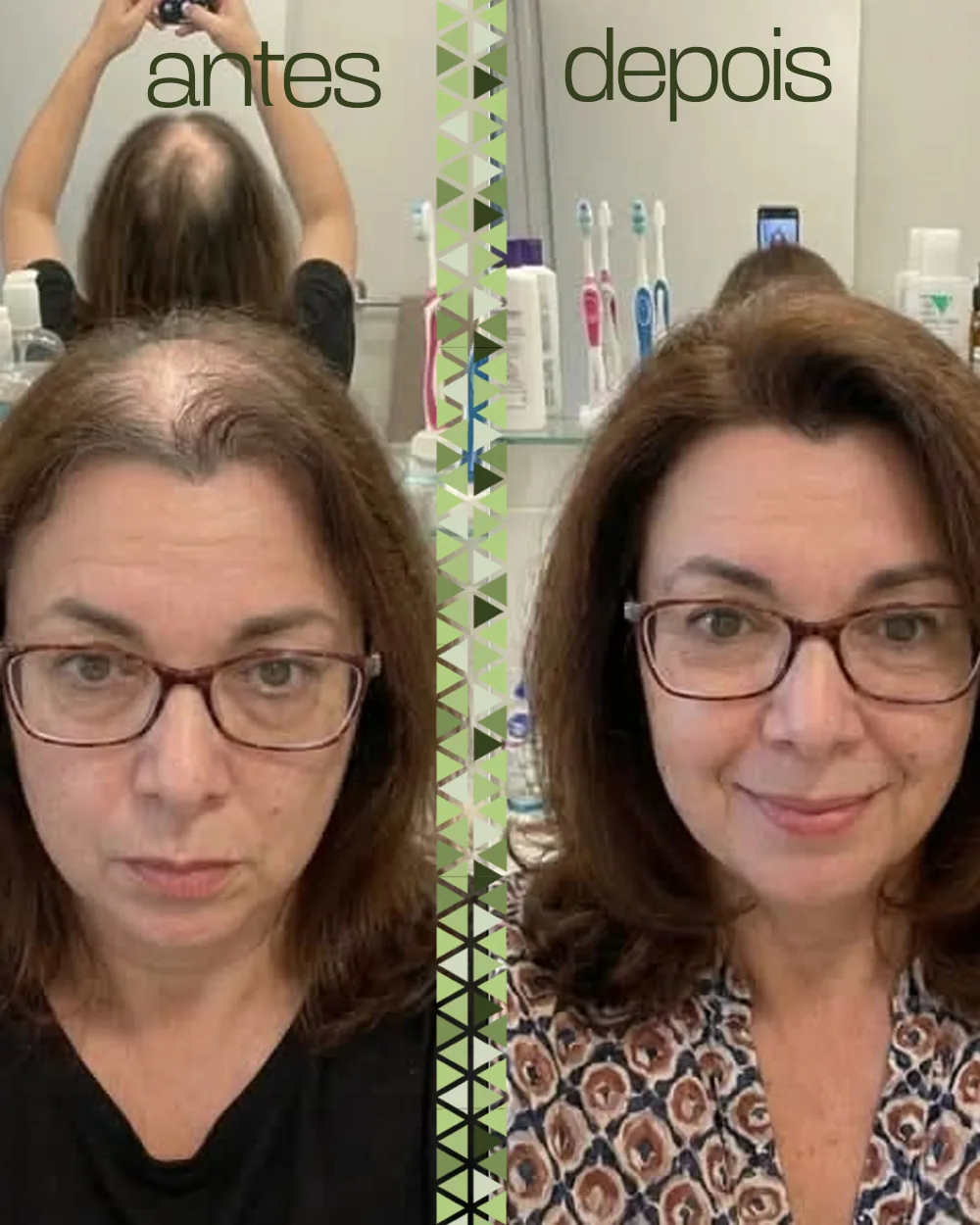 Antes e depois de frente, lado a lado, mostrando a linha do cabelo mais cheia.